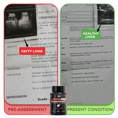 YogaManLab® Liver Pro - Fatty Liver Ayurvedic Supplement | Helps Restore Liver Health & Remove Toxins | 100% Natural & Ayurvedic | 28 Days Program