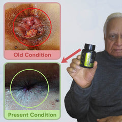 YogaManLab® PILES MATRIX - Piles Treatment Ayurvedic Capsules & Lepam Ointment | With Free Diet & Doctor | Treats Internal Grade1-4 & External Hemorrhoids | 100% Natural