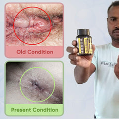 YogaManLab® PILES MATRIX - Piles Treatment Ayurvedic Capsules & Lepam Ointment | With Free Diet & Doctor | Treats Internal Grade1-4 & External Hemorrhoids | 100% Natural