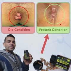 YogaManLab® PILES MATRIX - Piles Treatment Ayurvedic Capsules & Lepam Ointment | With Free Diet & Doctor | Treats Internal Grade1-4 & External Hemorrhoids | 100% Natural